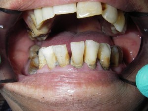 Cleaning (Scaling) Before