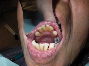 Cleaning (Scaling) After