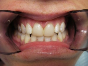 Porcelain Veneers Before