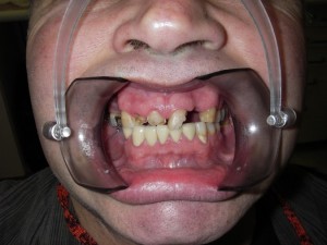 Smile Reconstruction Before