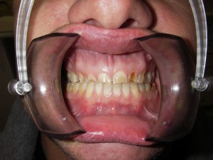 Smile Reconstruction Before