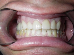 Smile Reconstruction After
