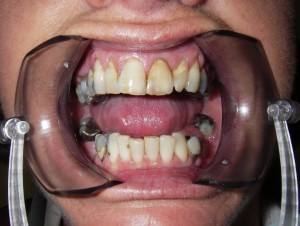 Smile Reconstruction Before